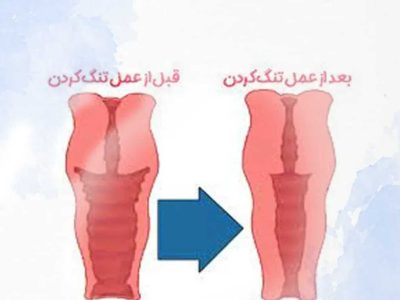 عکس قبل و بعد عمل تنگ کردن واژن