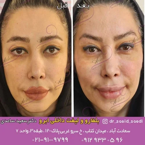 فواید بلفاروپلاستی برای زیبایی و جوانی چشم ها