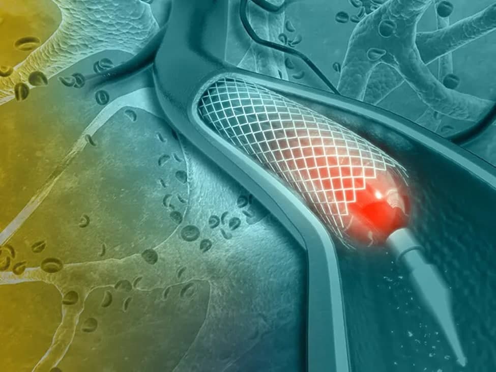 بالن قلب یا آنژیوپلاستی چیست و چه تاثیری در درمان گرفتگی عروق قلبی دارد؟