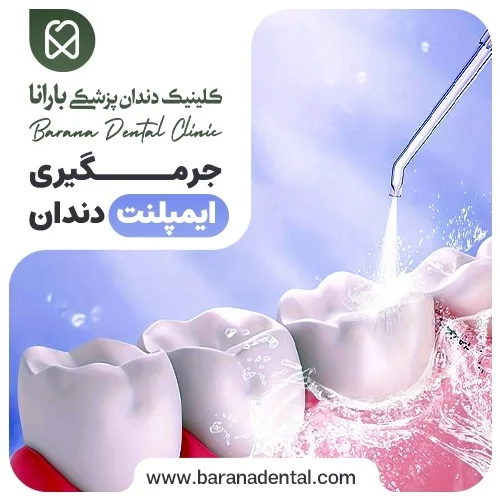 عوارض جرم گیری دندان