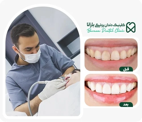 عوارض جرم گیری دندان