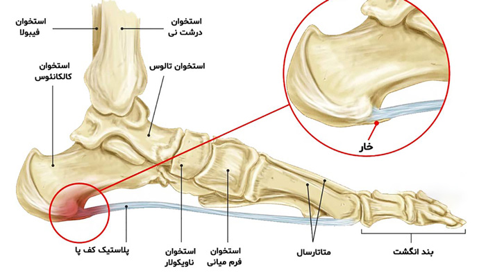 درد پاشنه پا و کمبود ویتامین های موثر در درمان آن