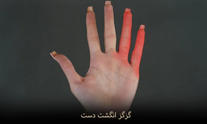 10 علت اصلی گزگز انگشت دست و نوک آن + ۵ روش درمان قطعی